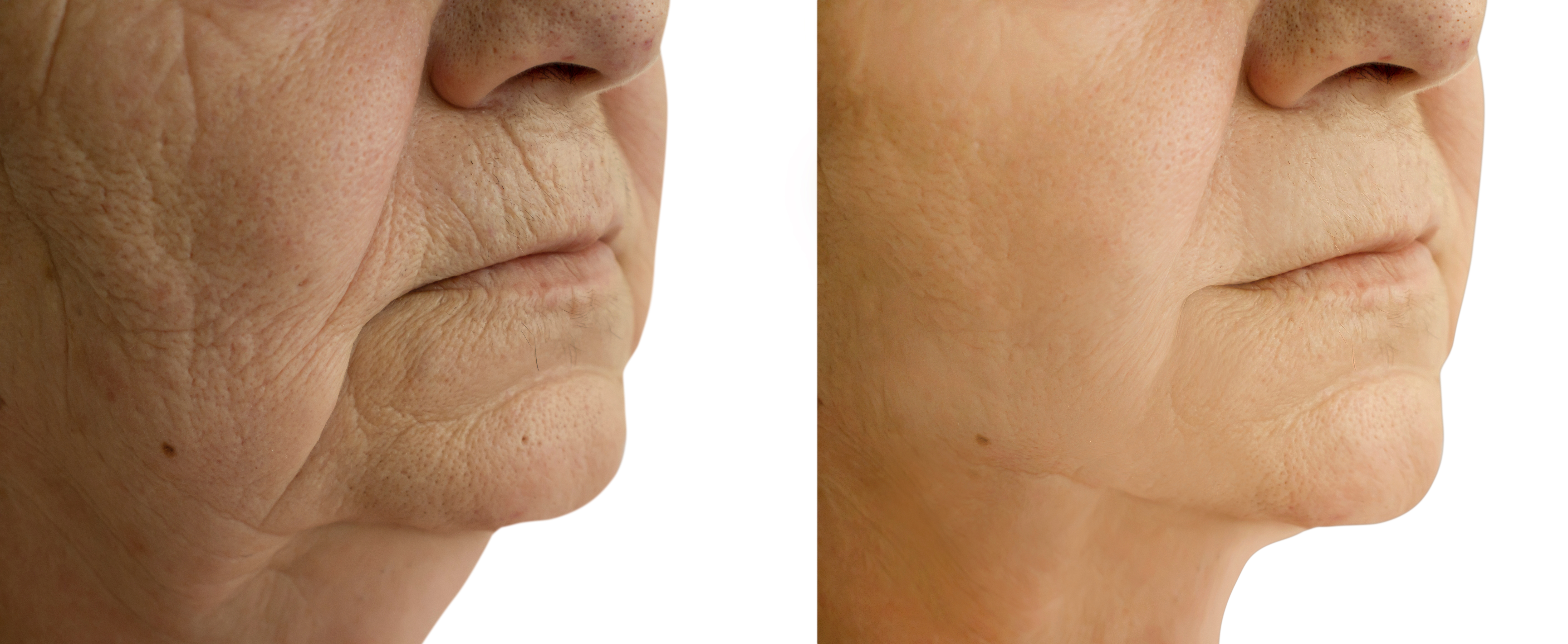 kaaklijn facelift kaaklijn facelift